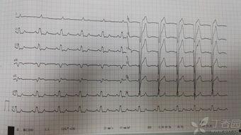 心电图吃瓜视频,揭秘心电图背后的趣味与知识
